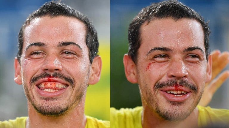 [FOTOS] Festa australiana após derrota Brasil acabou… em sangue