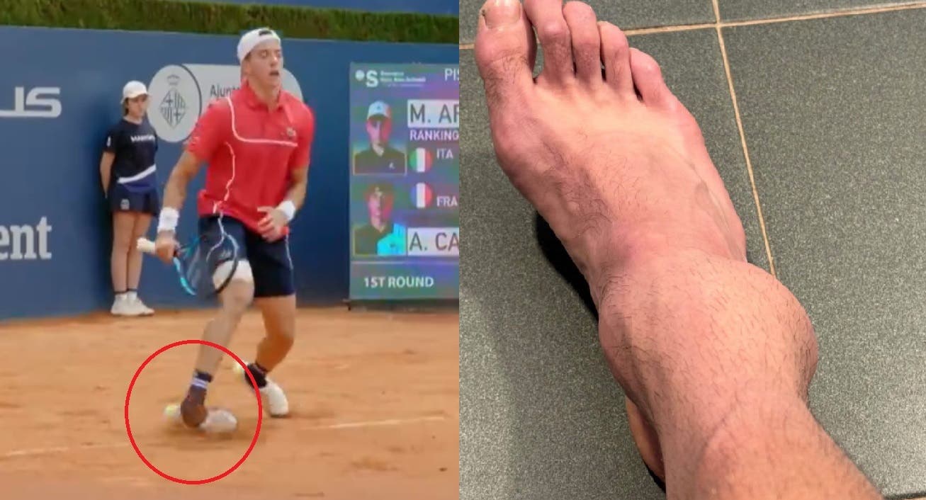 DE ARREPIAR: Cazaux torce o pé em Barcelona e compartilha imagem impactante da lesão